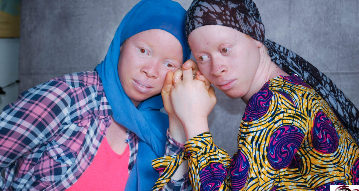 Guinée : à Nongo, une mobilisation citoyenne forte pour la dignité et l’inclusion des personnes atteintes d’albinisme